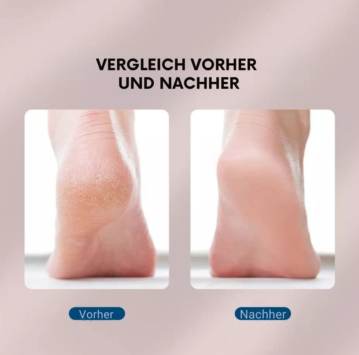 Serenosole™ SmoothSole | Verwandle deine Füße mit müheloser Glätte | Beste Fußpflege 2025