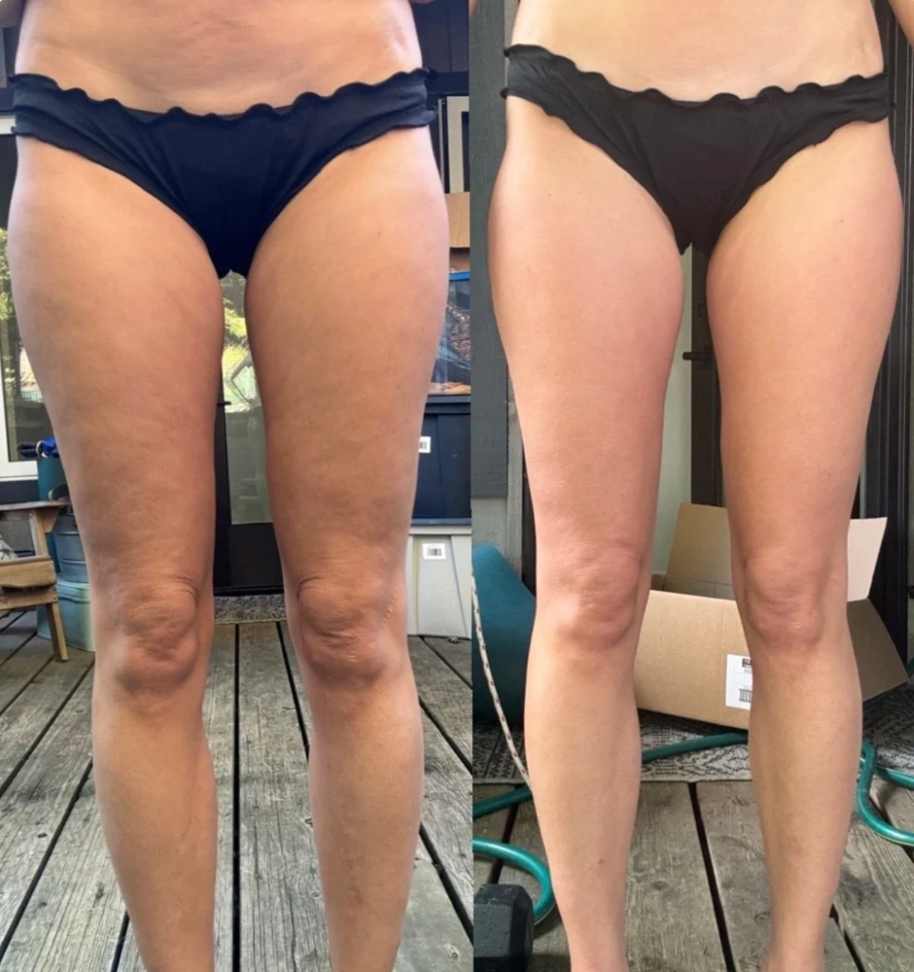 Serenosole™ CellaGlow anticellulitismassageapparaat | Voor een gladdere huid en ter verbetering van de bloedcirculatie | SlimSculpt 2024 (+GRATIS massageolie)