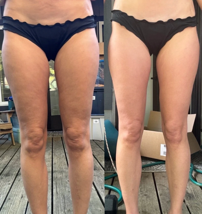 Serenosole™ CellaGlow anticellulitismassageapparaat | Voor een gladdere huid en ter verbetering van de bloedcirculatie | SlimSculpt 2024 (+GRATIS massageolie)